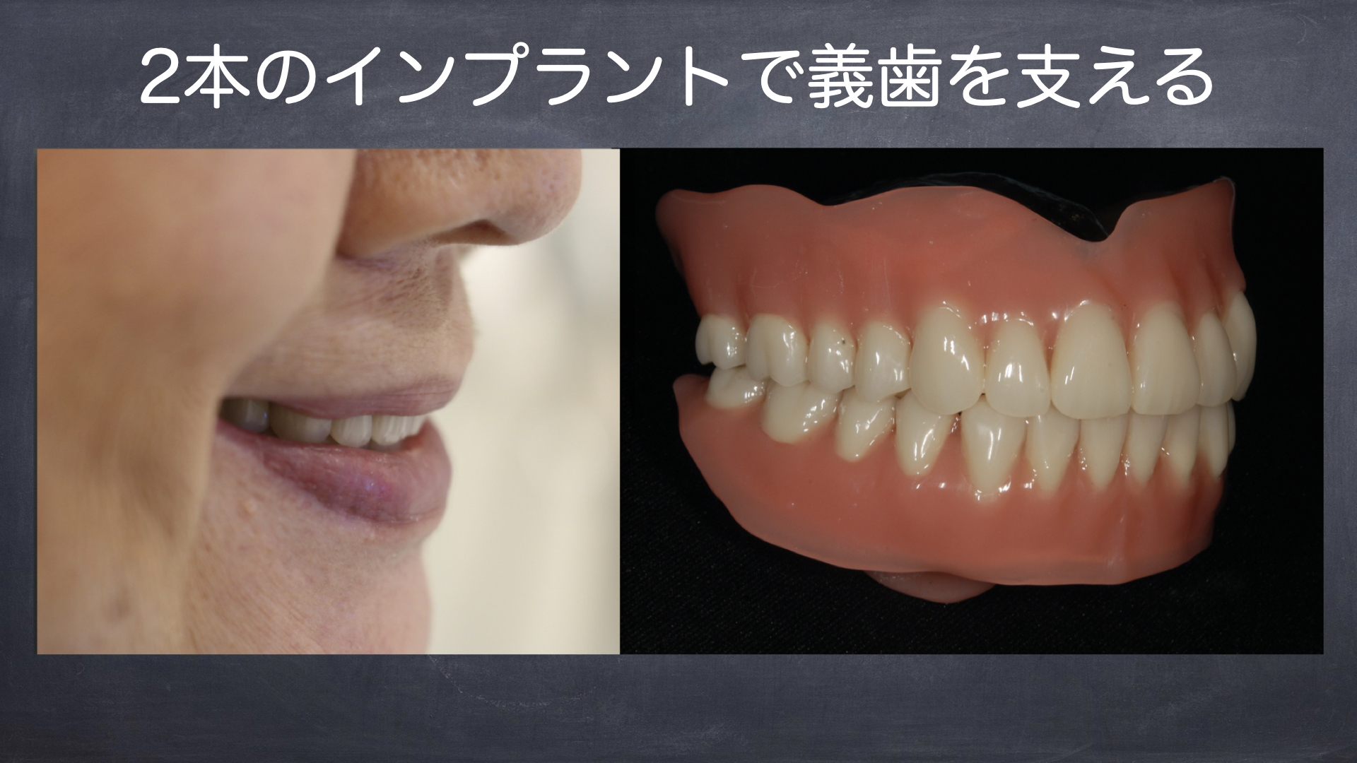 インプラントを併用した入れ歯の症例