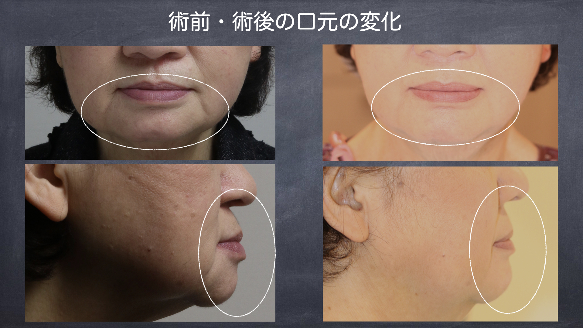 口元が変わる義歯（入れ歯）治療