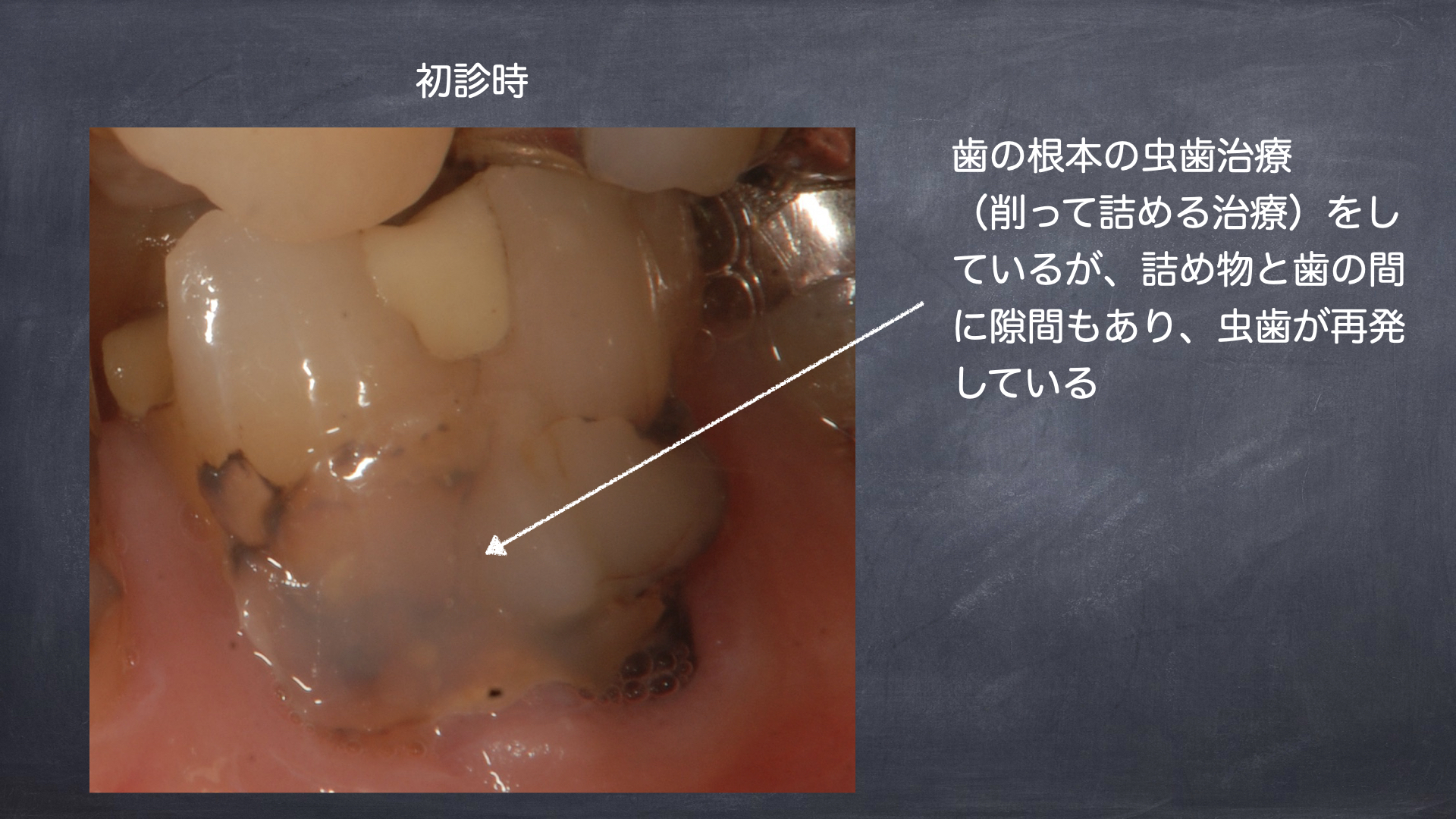 虫歯予防と歯磨きの関係
