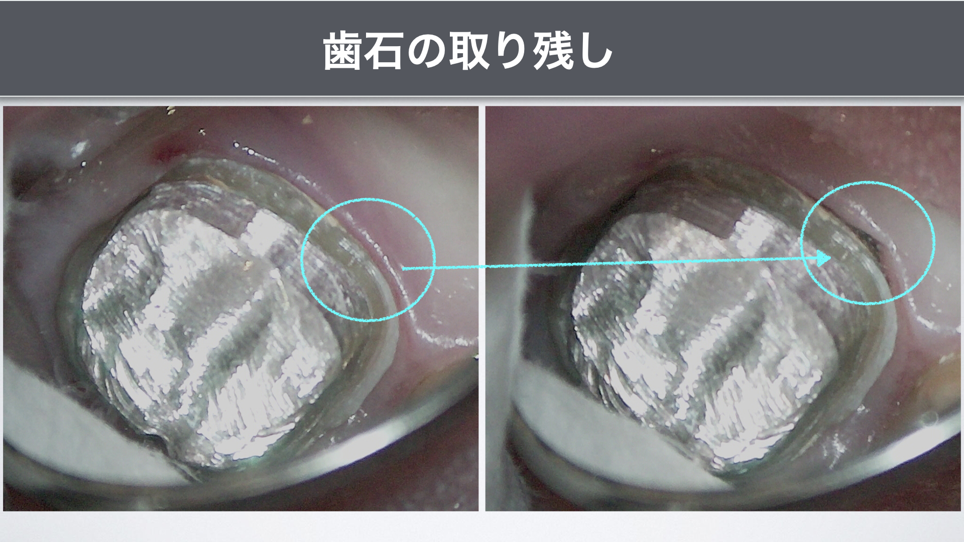 マイクロスコープを用いた歯周病治療