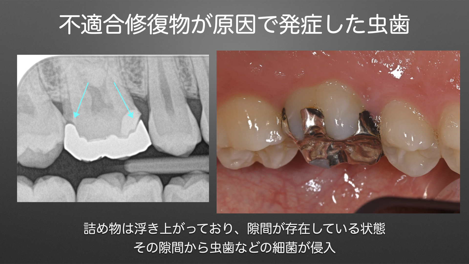 保険治療の落とし穴